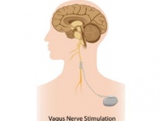 Эпилепсия: Лечение стимуляцией блуждающего нерва 